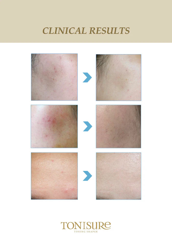 Clinical results of a hair removal product by Tonisure on various skin conditions.