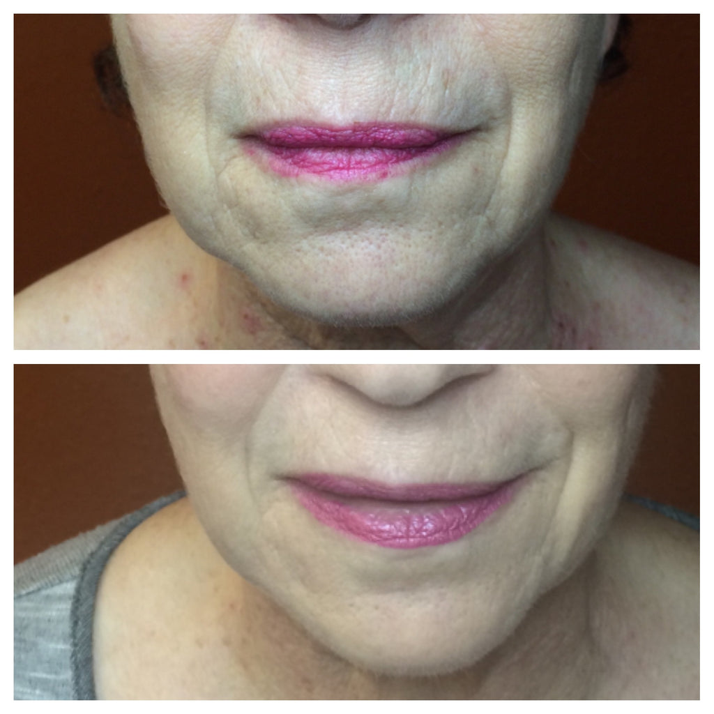 Microcurrent “non-Surgical Facelift”