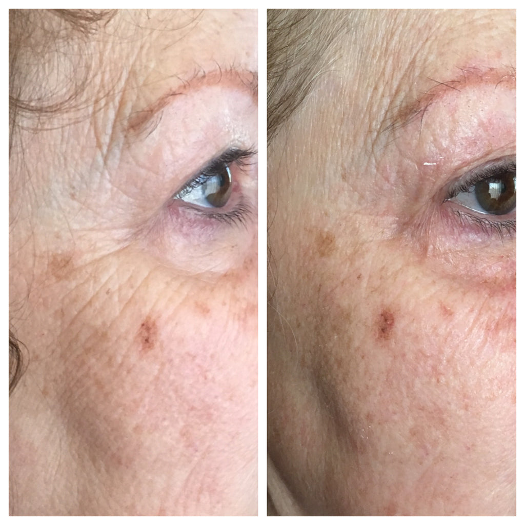 Microcurrent “non-Surgical Facelift”